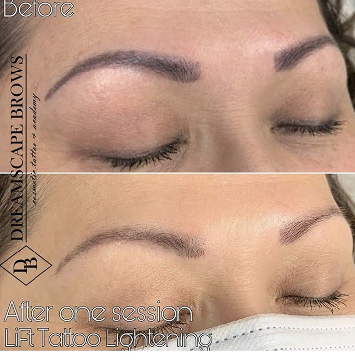 LASER TATTOO & PMU REMOVAL • PHILADELPHIA AREA | Eyebrow tattoo removal in  progress⚡️Case: eyebrows done 8 years ago, 3 times. Based on a bluish color  and density the ink was implant... | Instagram