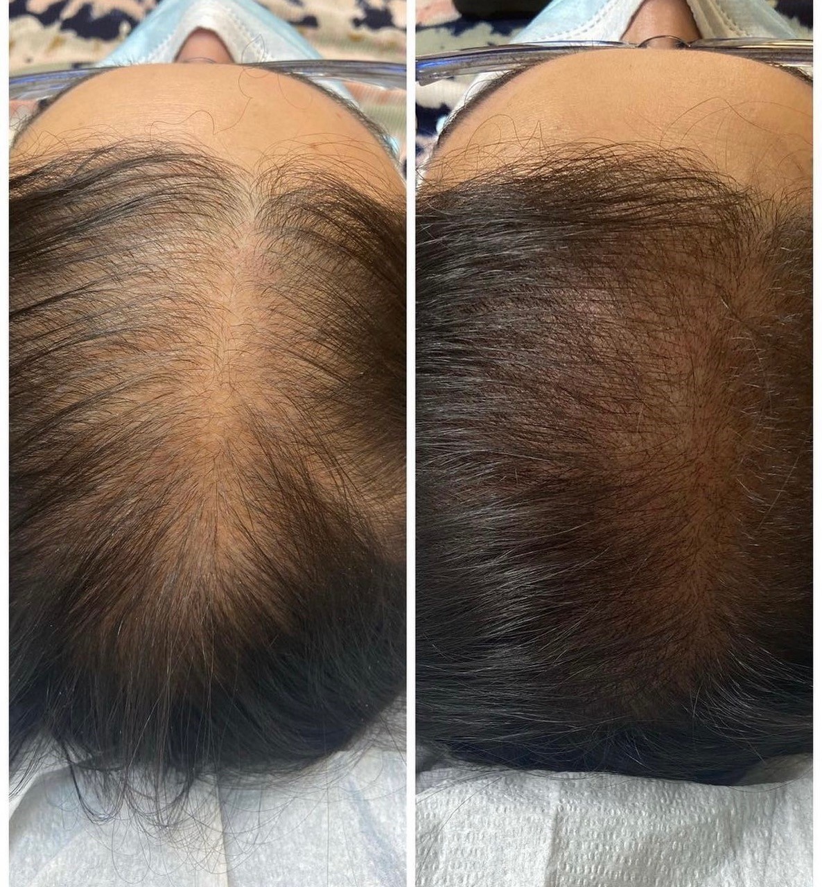 Scalp micropigmentation adding density for a woman