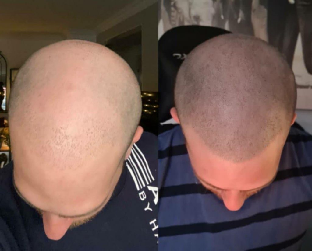 Before and after scalp micropigmentation — man's buzz-cut result