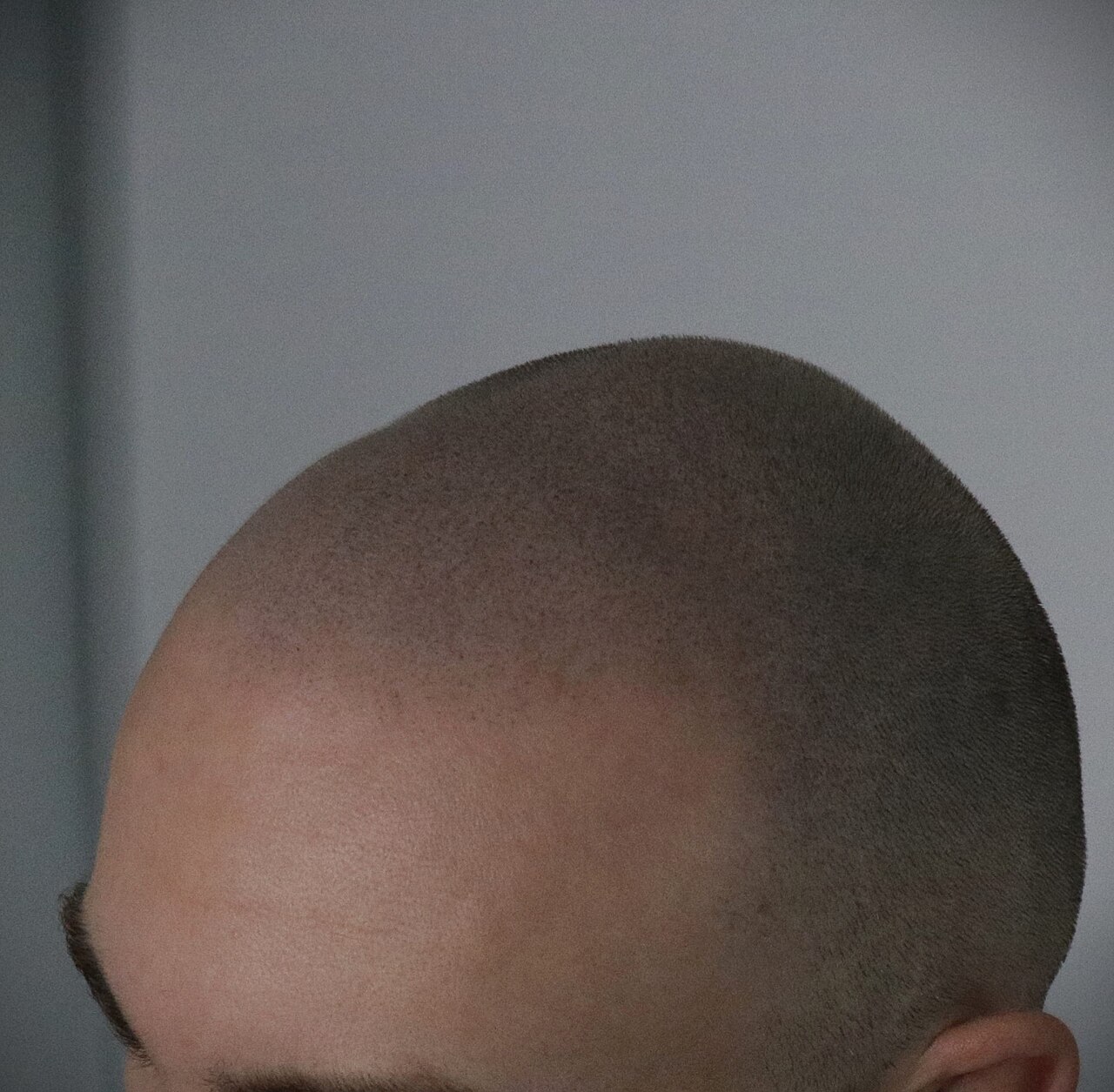 Close-up scalp micropigmentation result on a man