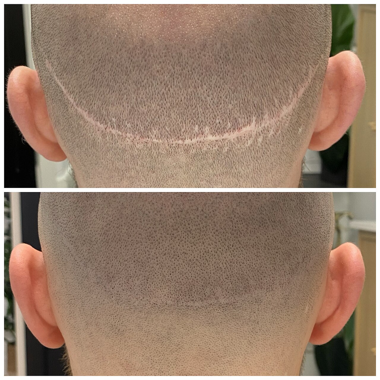 Scar camouflage scalp micropigmentation example