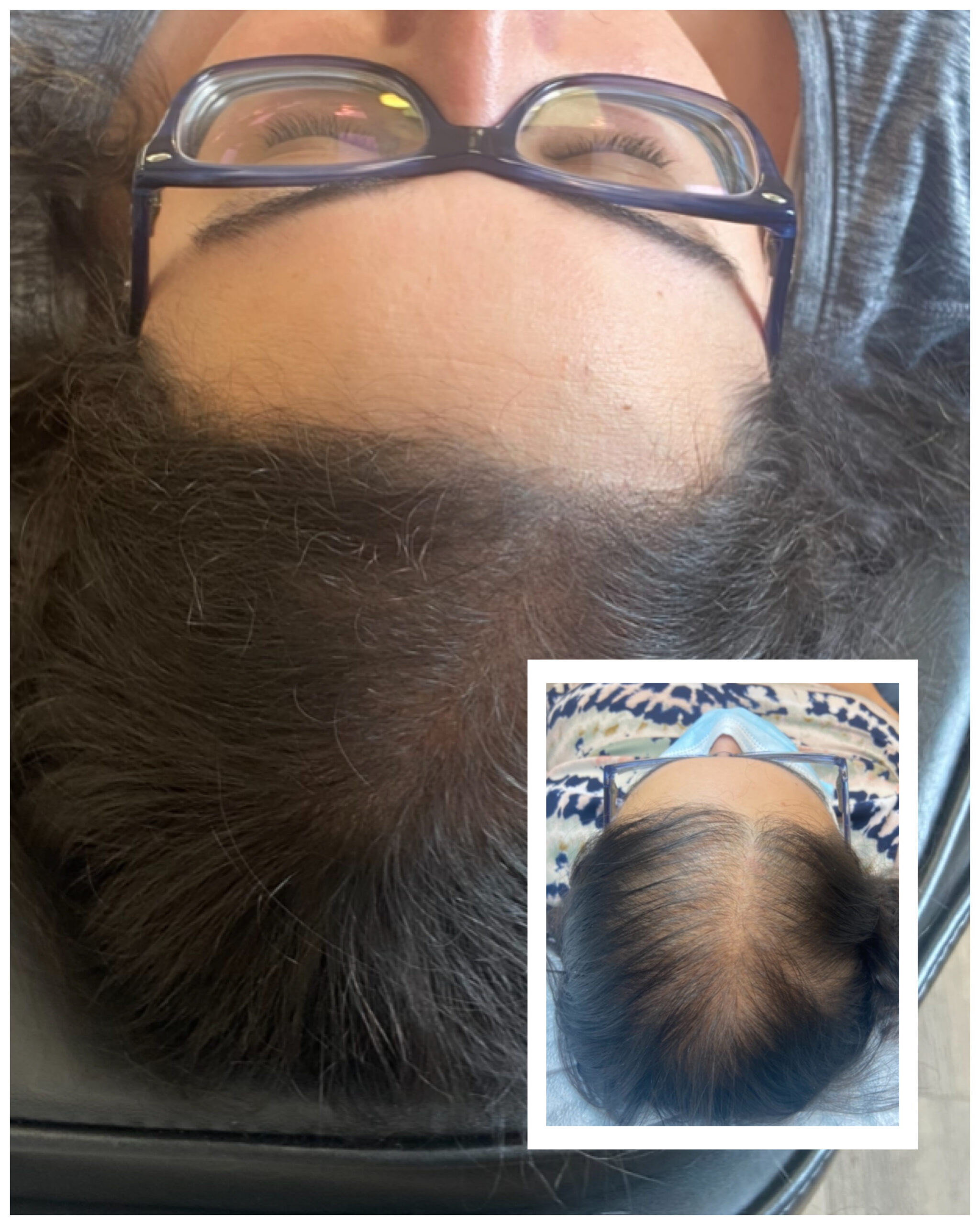 Scalp micropigmentation adding density for a woman
