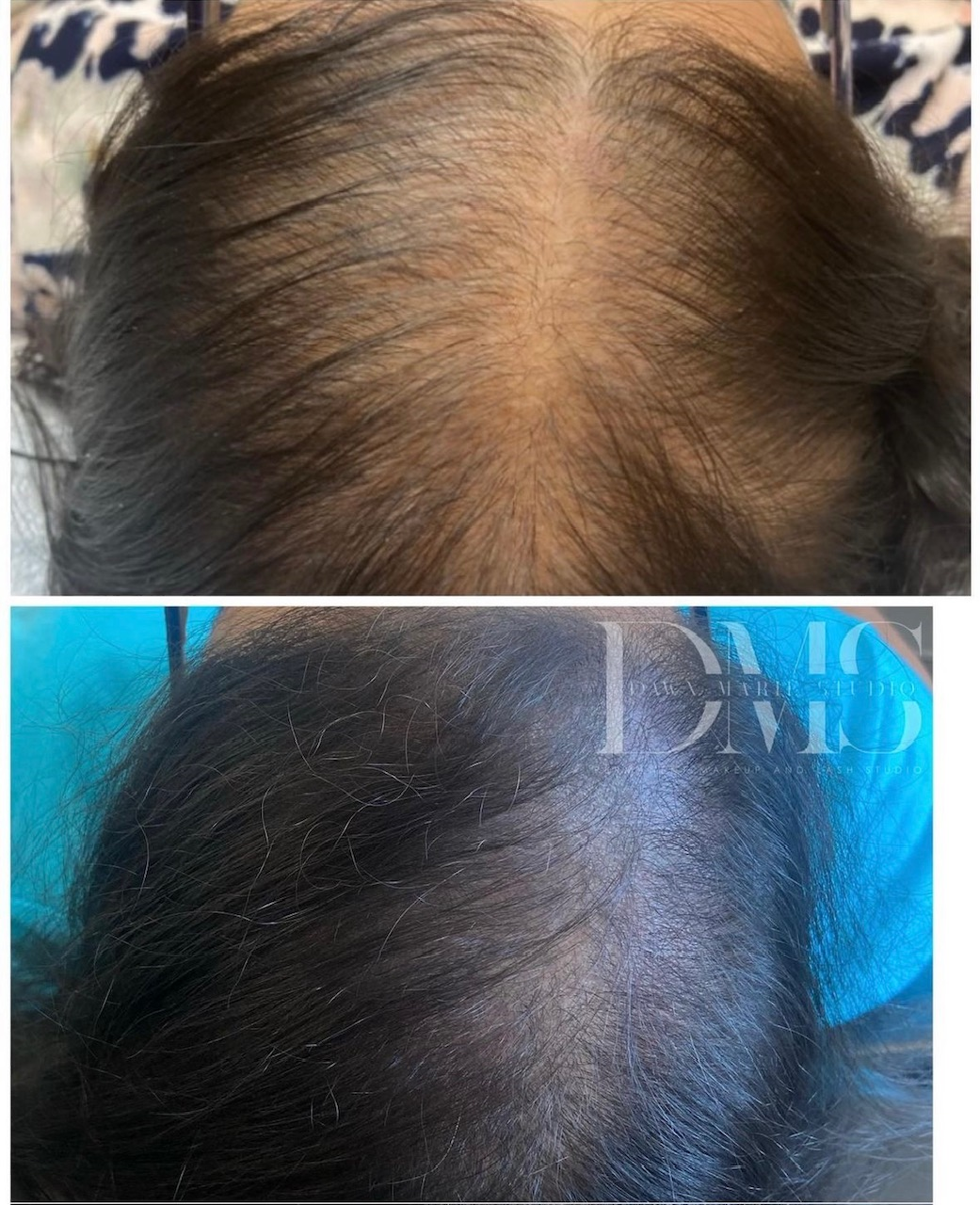Scalp micropigmentation adding density for a woman