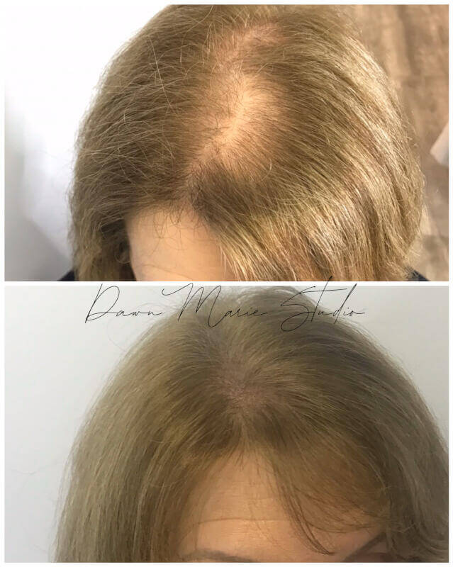 Scalp micropigmentation adding density for a woman
