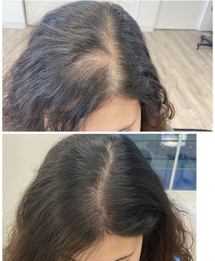 Scalp micropigmentation adding density for a woman