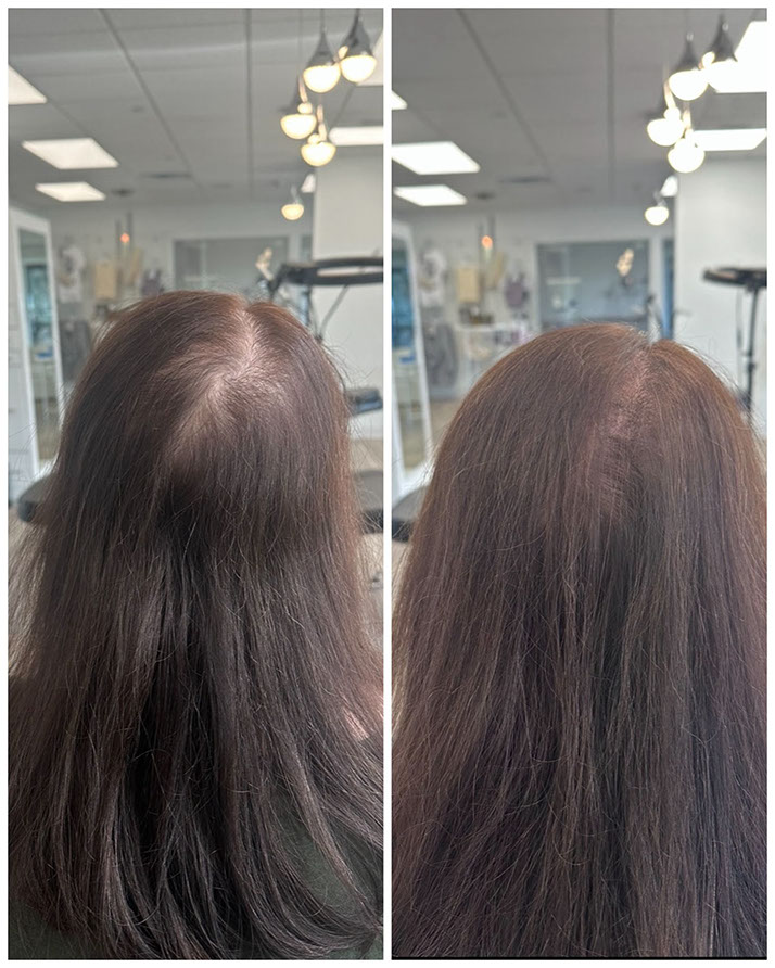 Scalp micropigmentation adding density for a woman