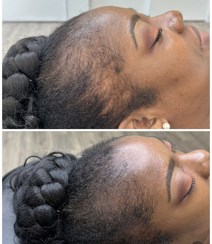 Scalp micropigmentation adding density for a woman
