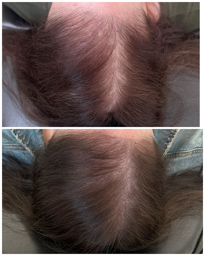 Scalp micropigmentation adding density for a woman