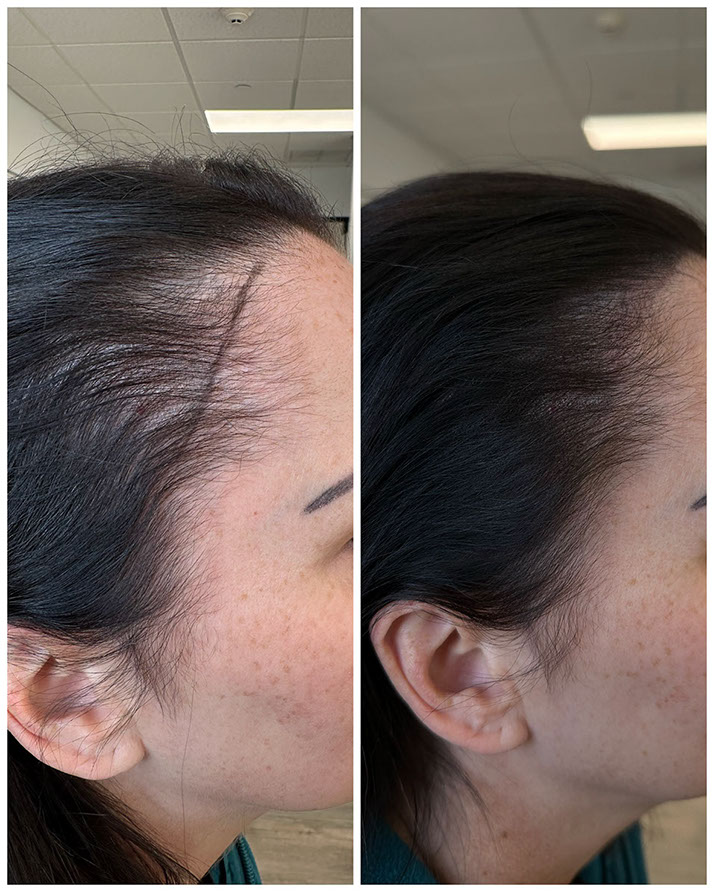 Scalp micropigmentation adding density for a woman
