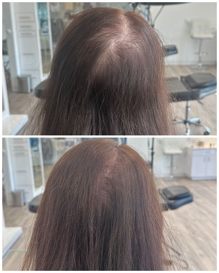 Scalp micropigmentation adding density for a woman