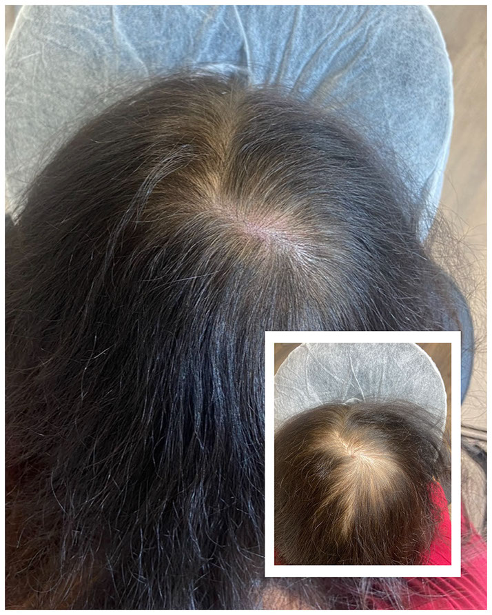 Scalp micropigmentation adding density for a woman
