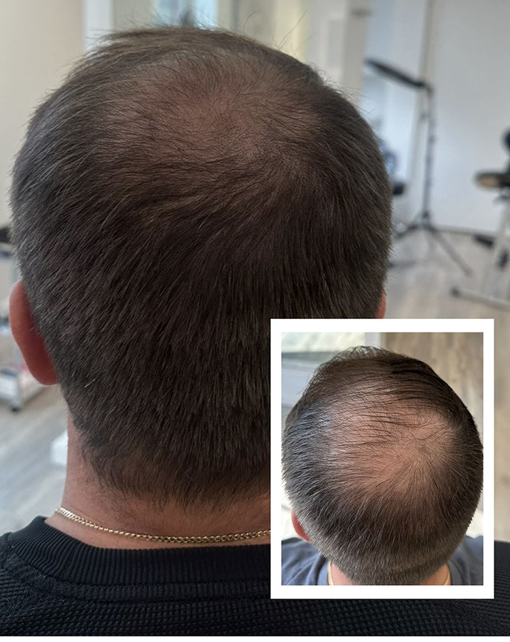 Scalp micropigmentation result on a man