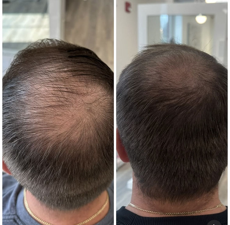 Scalp micropigmentation result on a man
