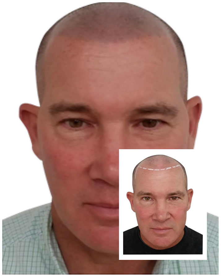 Scalp micropigmentation result on a man