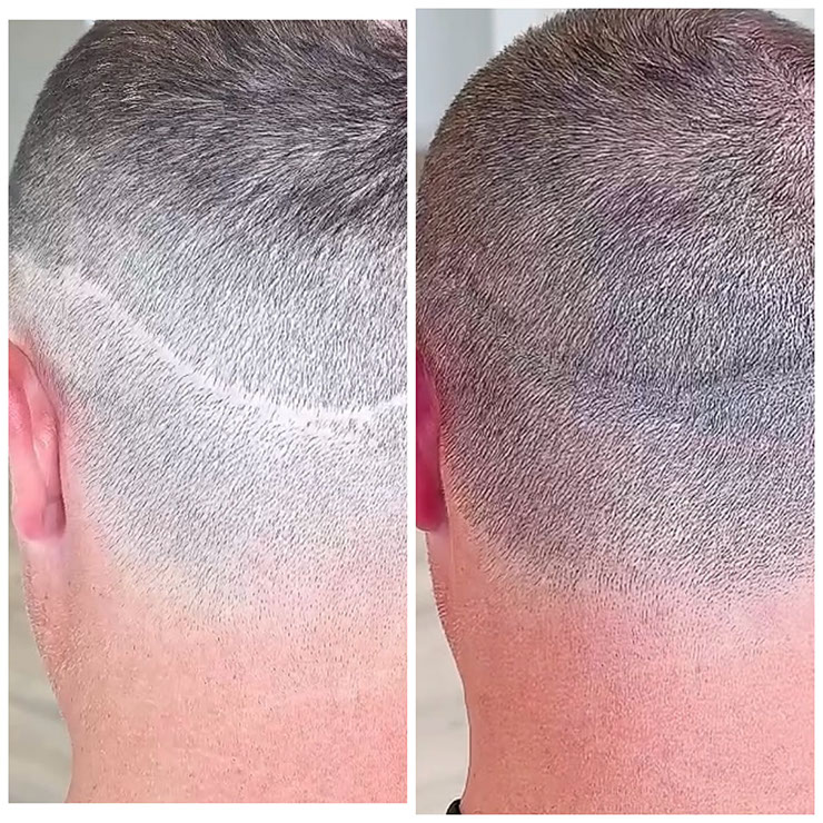 Scalp micropigmentation result on a man