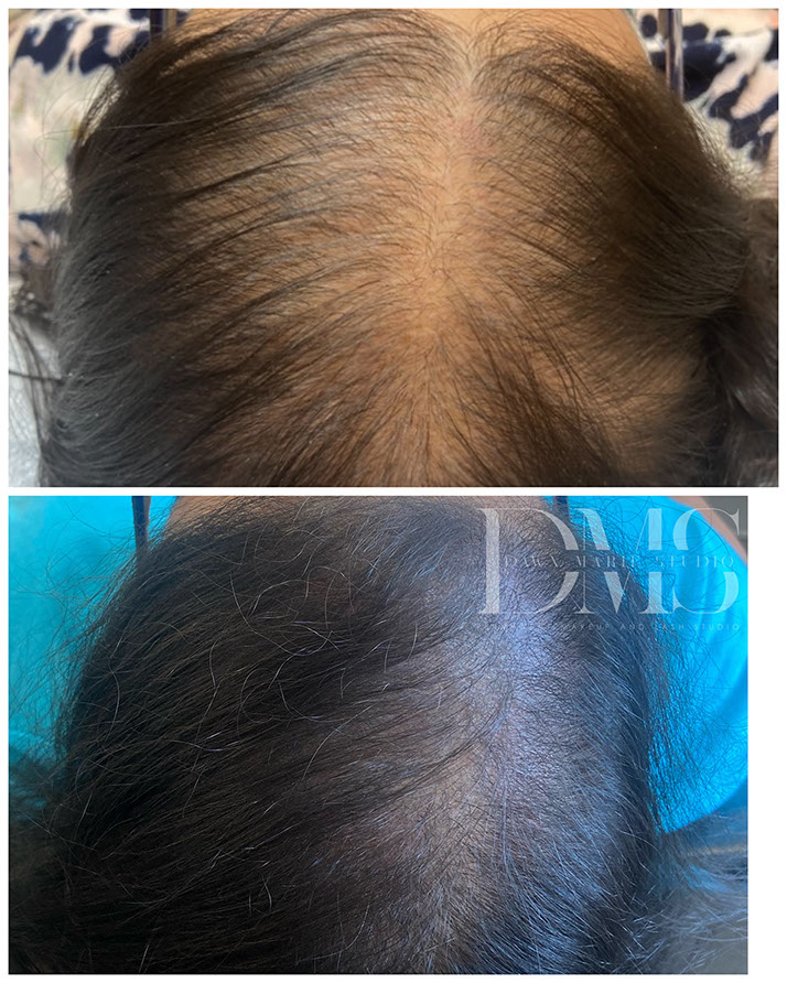 Scalp micropigmentation adding density for a woman