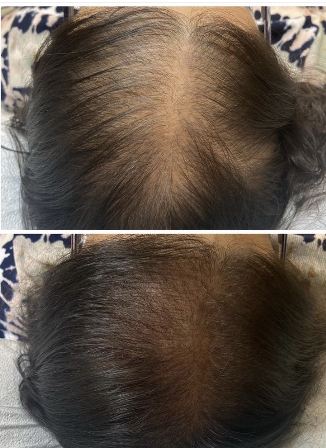 Scalp micropigmentation adding density for a woman