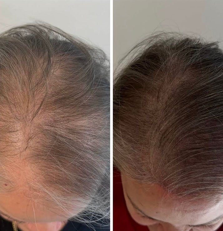 Scalp micropigmentation adding density for a woman