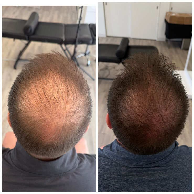 Scalp micropigmentation result on a man