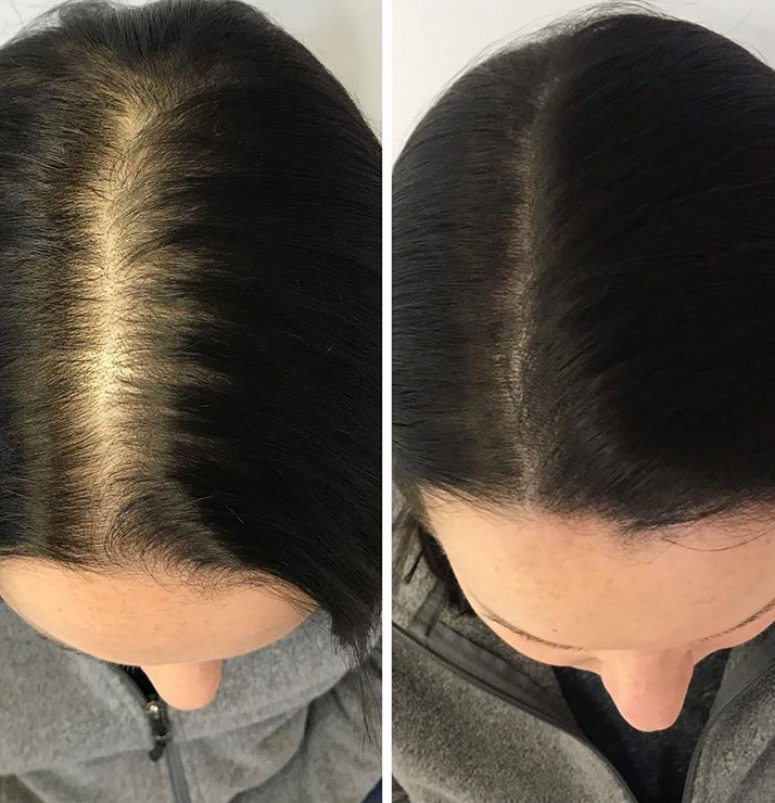 Scalp micropigmentation adding density for a woman