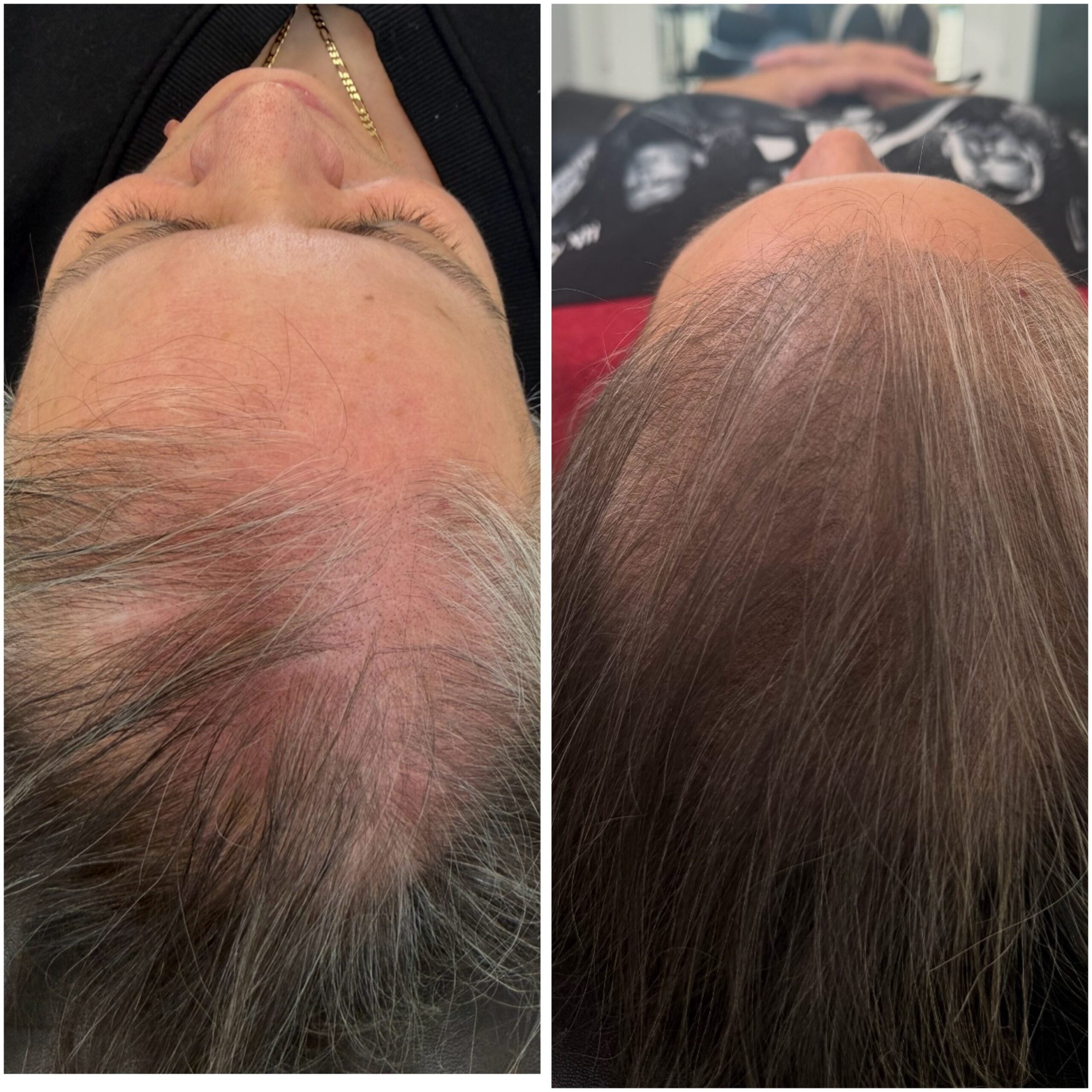 Scalp micropigmentation adding density for a woman
