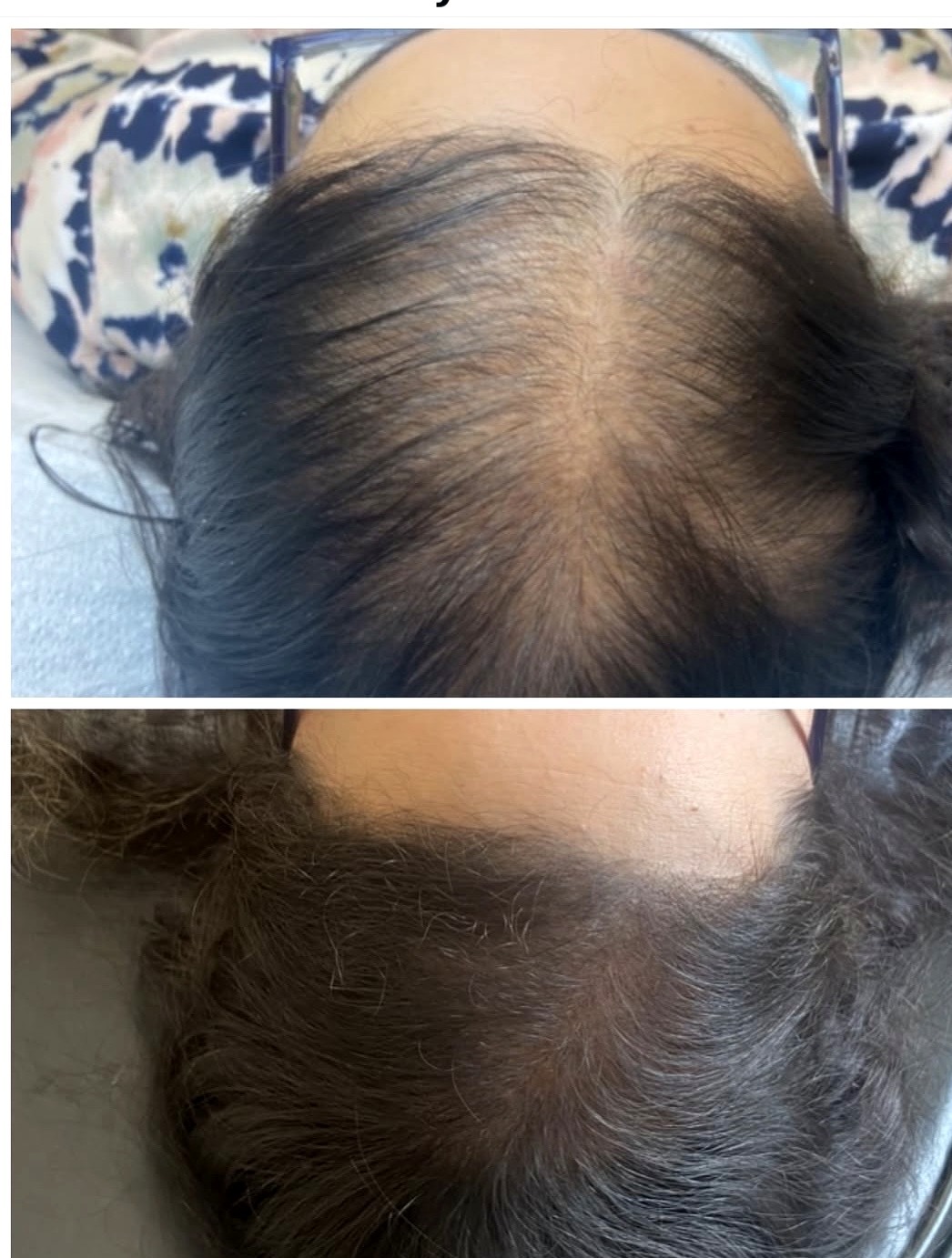 Scalp micropigmentation adding density for a woman