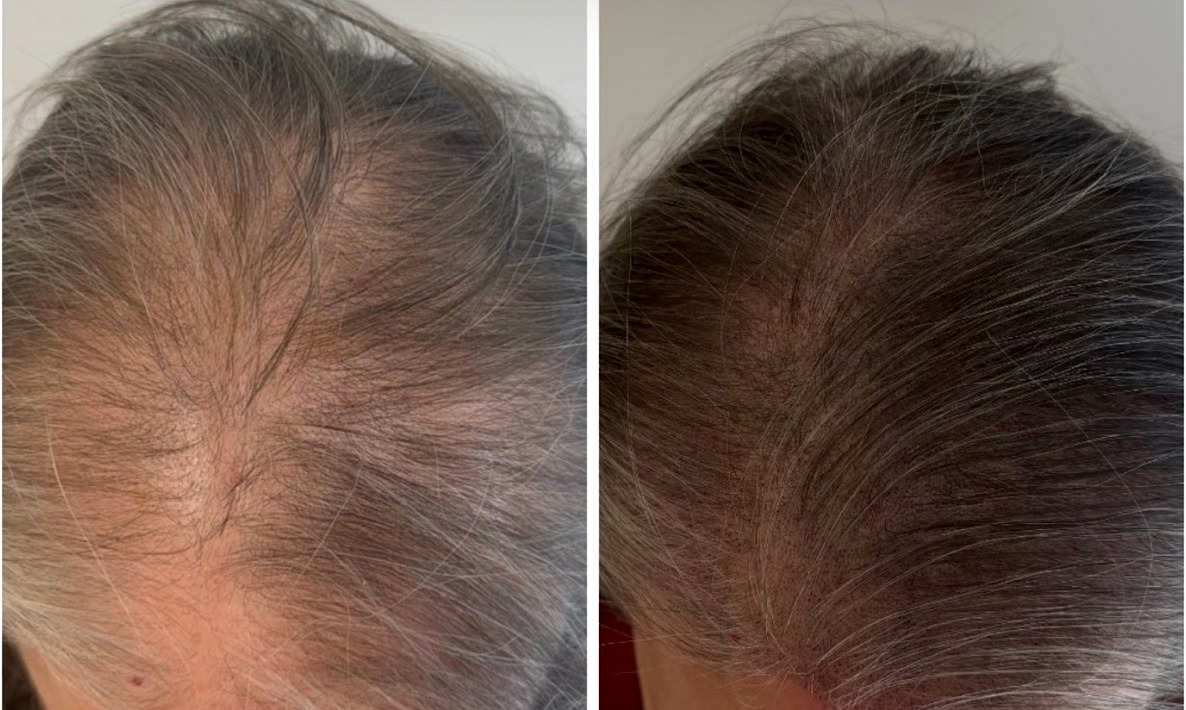 Wanda Santiago before and after scalp micropigmentation